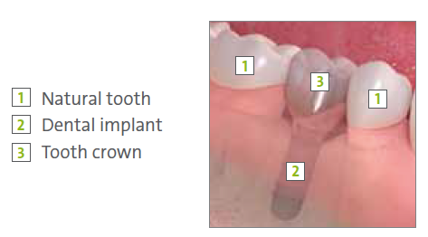 Dental Implants North Hollywood CA