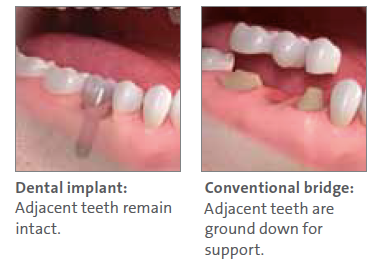 Dental Implant Procedure North Hollywood CA