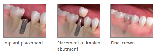Implant Dentistry North Hollywood CA