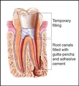 Endodontic Therapy North Hollywood, CA