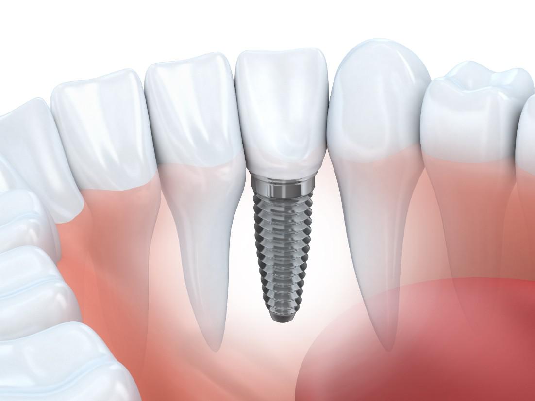 Dental Implants North Hollywood, CA