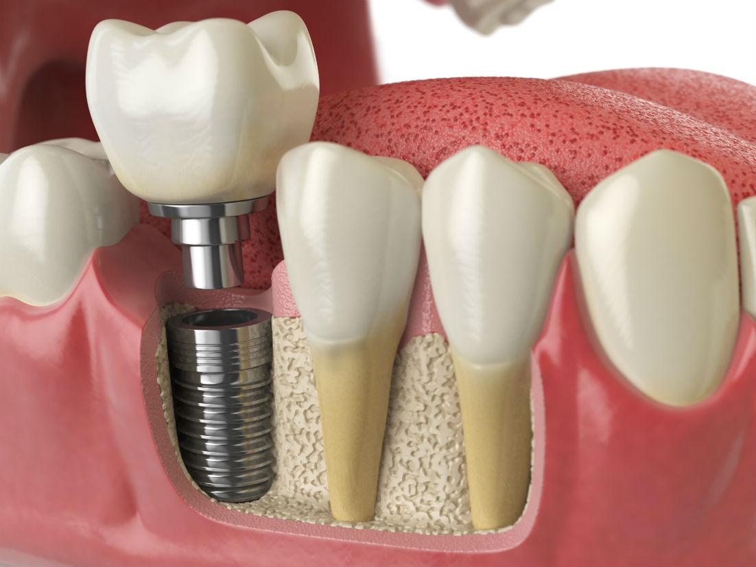 Dental Implants North Hollywood CA