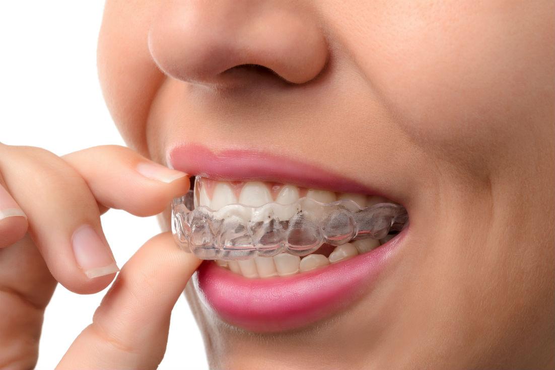 Invisalign North Hollywood CA